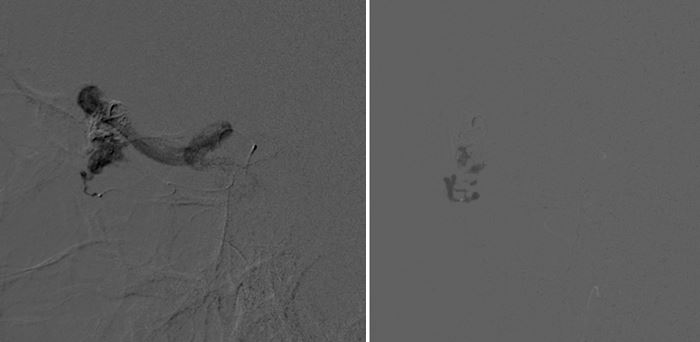 pedicle2-glue