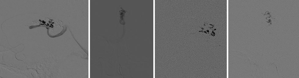 pedicle2-pericallosal