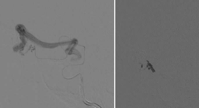 pedicle3-glue