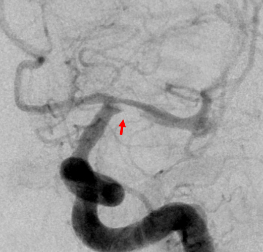 post-dilatation