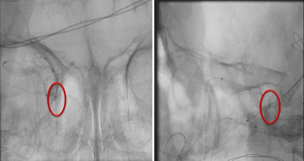 rcs-catheterization