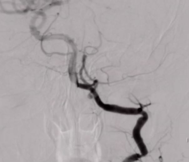 revascularization-left-VA