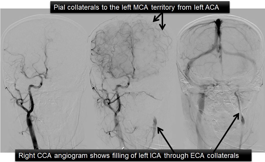 right-cca-angio