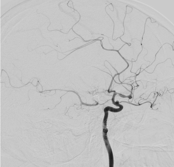 severe-vasospasm