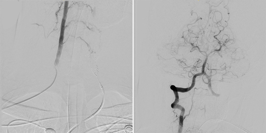 transvenous-avf