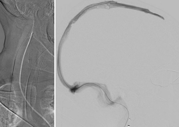 venous-access