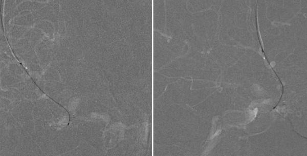 venous-access02