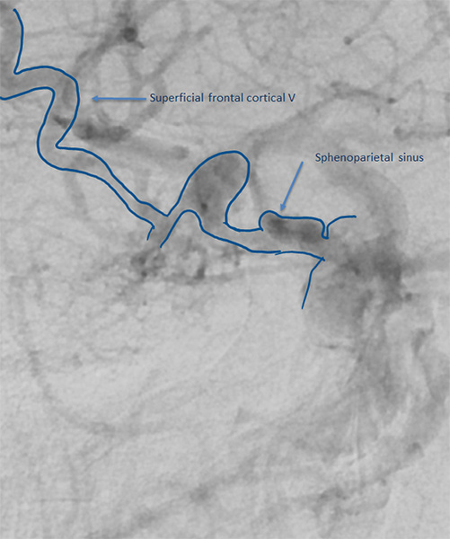 venous-drainage02