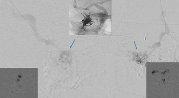 venous-injection