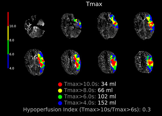 CTP Summary (2) - Favourable Hypoperfusion index, suggests good collaterals