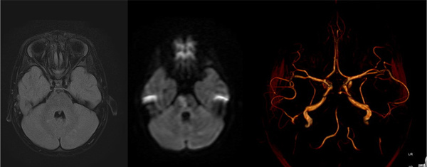 A friend in need is a friend indeed – Ischemic stroke case there SOFIA made all the difference - Figure 1