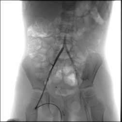 A friend in need is a friend indeed – Ischemic stroke case there SOFIA made all the difference - Figure 2