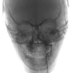A friend in need is a friend indeed – Ischemic stroke case there SOFIA made all the difference - Figure 3