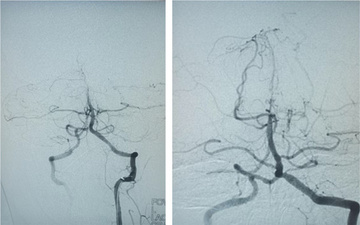 A friend in need is a friend indeed – Ischemic stroke case there SOFIA made all the difference - Figure 4