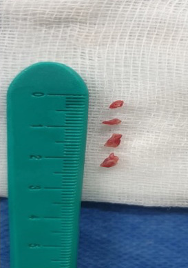 A friend in need is a friend indeed – Ischemic stroke case there SOFIA made all the difference - Figure 5