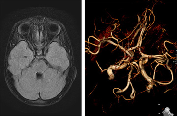 A friend in need is a friend indeed – Ischemic stroke case there SOFIA made all the difference - Figure 6