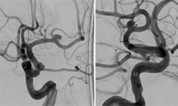 rescue-thrombectomy-in-post-procedural-fd-thrombosis-figure1