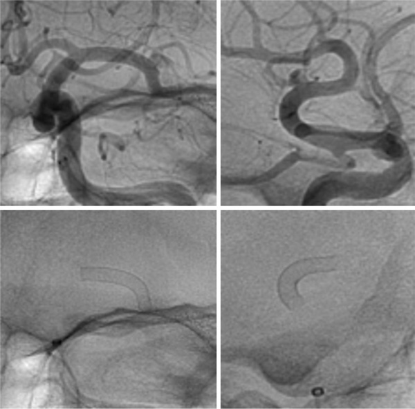 rescue-thrombectomy-in-post-procedural-fd-thrombosis-figure2