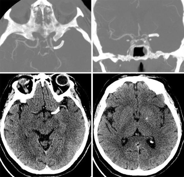 rescue-thrombectomy-in-post-procedural-fd-thrombosis-figure3