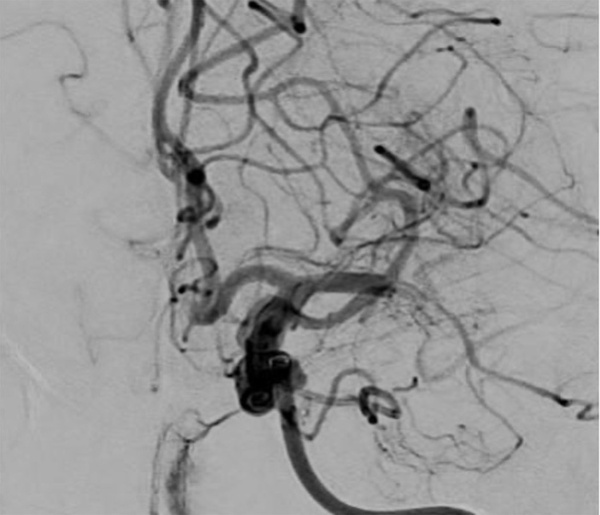 rescue-thrombectomy-in-post-procedural-fd-thrombosis-figure4