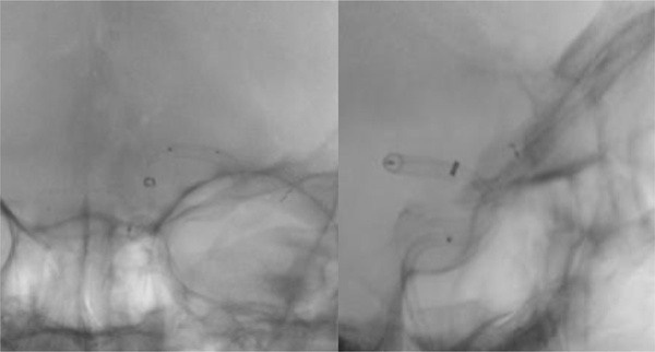 rescue-thrombectomy-in-post-procedural-fd-thrombosis-figure5