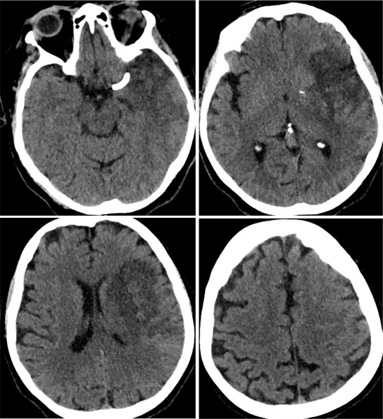 rescue-thrombectomy-in-post-procedural-fd-thrombosis-figure6