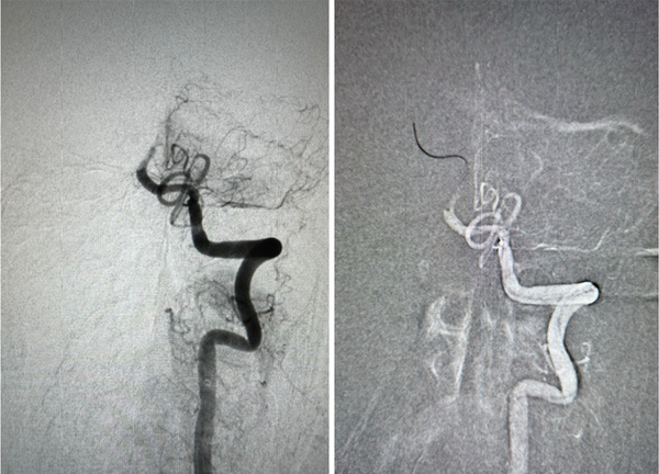 Figure 1 - Solumbra for foreign body retrieval