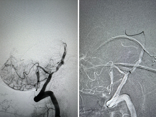 Figure 2 - Solumbra for foreign body retrieval