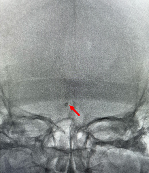 Figure 4 - Solumbra for foreign body retrieval