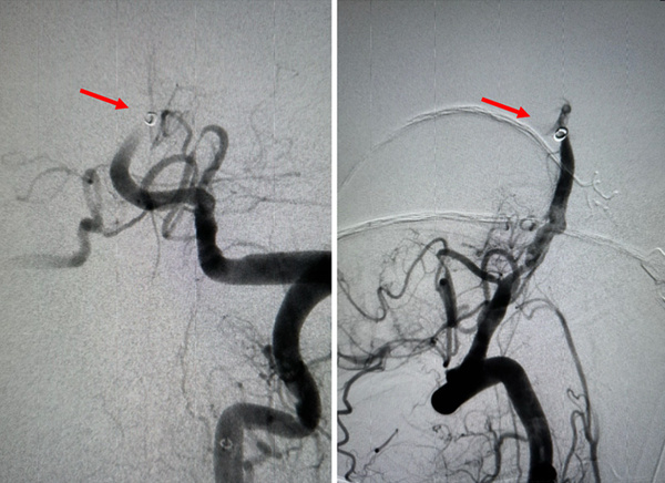 Figure 5 - Solumbra for foreign body retrieval