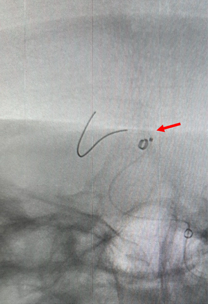 Figure 6 - Solumbra for foreign body retrieval