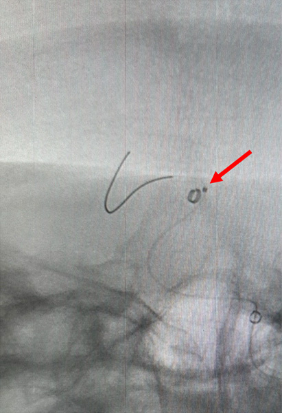 Figure 7 - Solumbra for foreign body retrieval