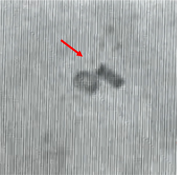 Figure 8 - Solumbra for foreign body retrieval