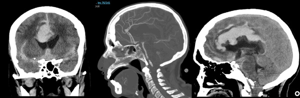 Figure 1 - WEB + coil of a ruptured DACA aneurysm