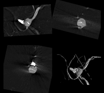 Figure 10 - WEB + coil of a ruptured DACA aneurysm