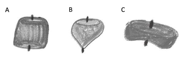 Figure 11 - WEB + coil of a ruptured DACA aneurysm