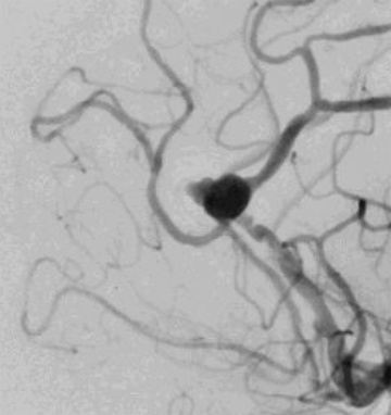 Figure 2 - WEB + coil of a ruptured DACA aneurysm
