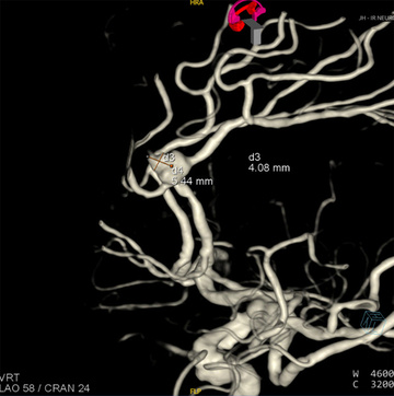 Figure 3 - WEB + coil of a ruptured DACA aneurysm