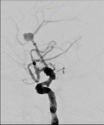 Figure 4 - WEB + coil of a ruptured DACA aneurysm