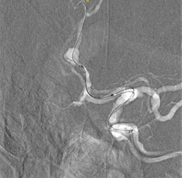 Figure 5 - WEB + coil of a ruptured DACA aneurysm
