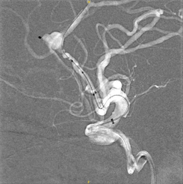 Figure 6 - WEB + coil of a ruptured DACA aneurysm