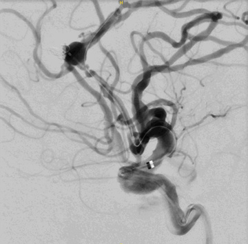 Figure 8 - WEB + coil of a ruptured DACA aneurysm