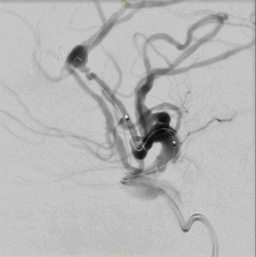 Figure 9 - WEB + coil of a ruptured DACA aneurysm