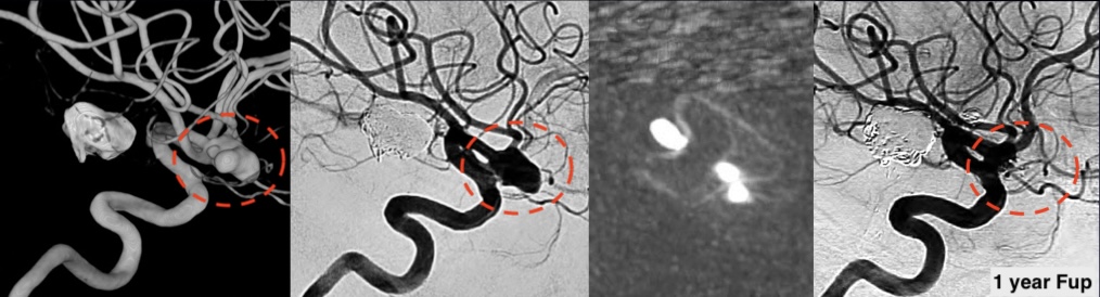 First WEB treatment performed in the Pr Spelle & Moret depart ment in 2012