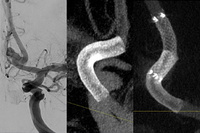 Non-ruptured ACom aneurysm with Vantage flow diverter - Special report: Future of Flow Diversion