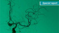 WEB device : Pioneering the intrasaccular revolution