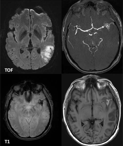 Are wide-neck and highly irregularly shaped MCA ruptured aneurysms always a good indication for surgery - Figure 1