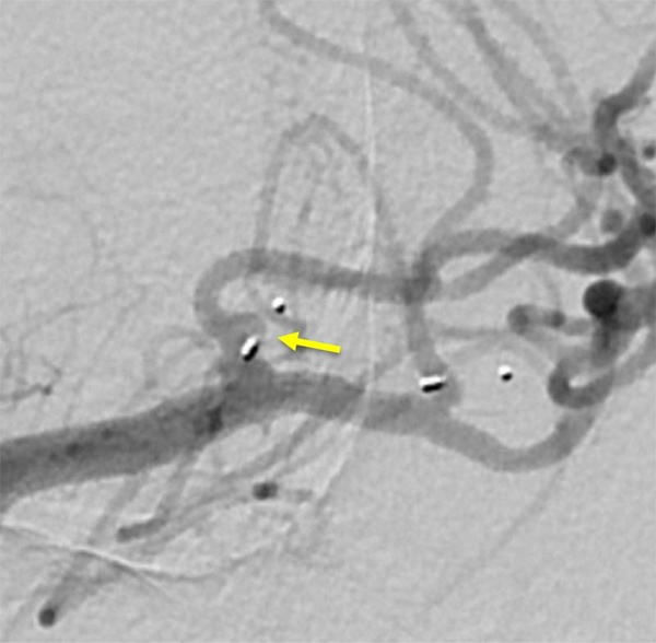 Are wide-neck and highly irregularly shaped MCA ruptured aneurysms always a good indication for surgery - Figure 11