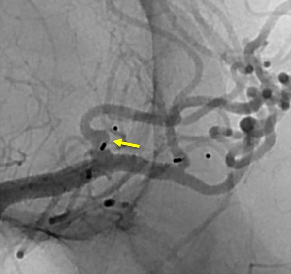 Are wide-neck and highly irregularly shaped MCA ruptured aneurysms always a good indication for surgery - Figure 12