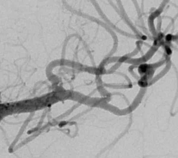 Are wide-neck and highly irregularly shaped MCA ruptured aneurysms always a good indication for surgery - Figure 13